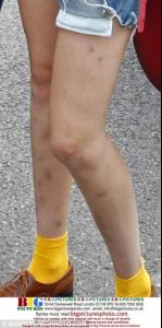 ADbruise3.jpg